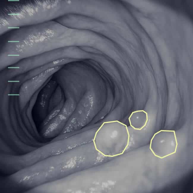 Lesion detection and phase identification for Robotic-Assisted Surgery & Endoscopy and Medical AI applications