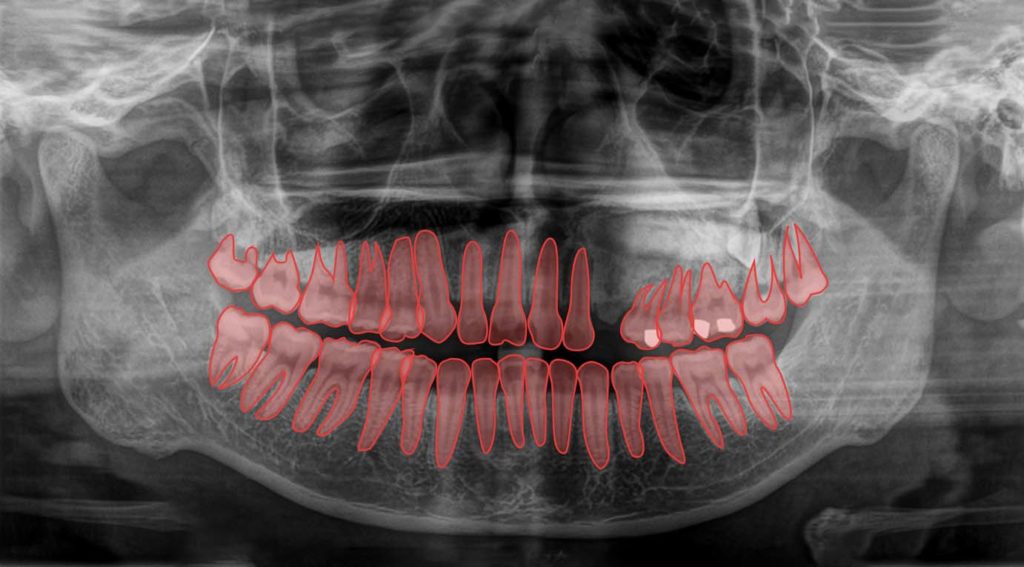 The Catch-22 - Polygon annotation of teeth