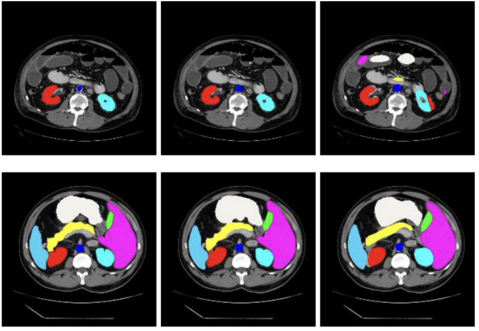 AI-generated segmentation of abdominal organs using TransUNet model.