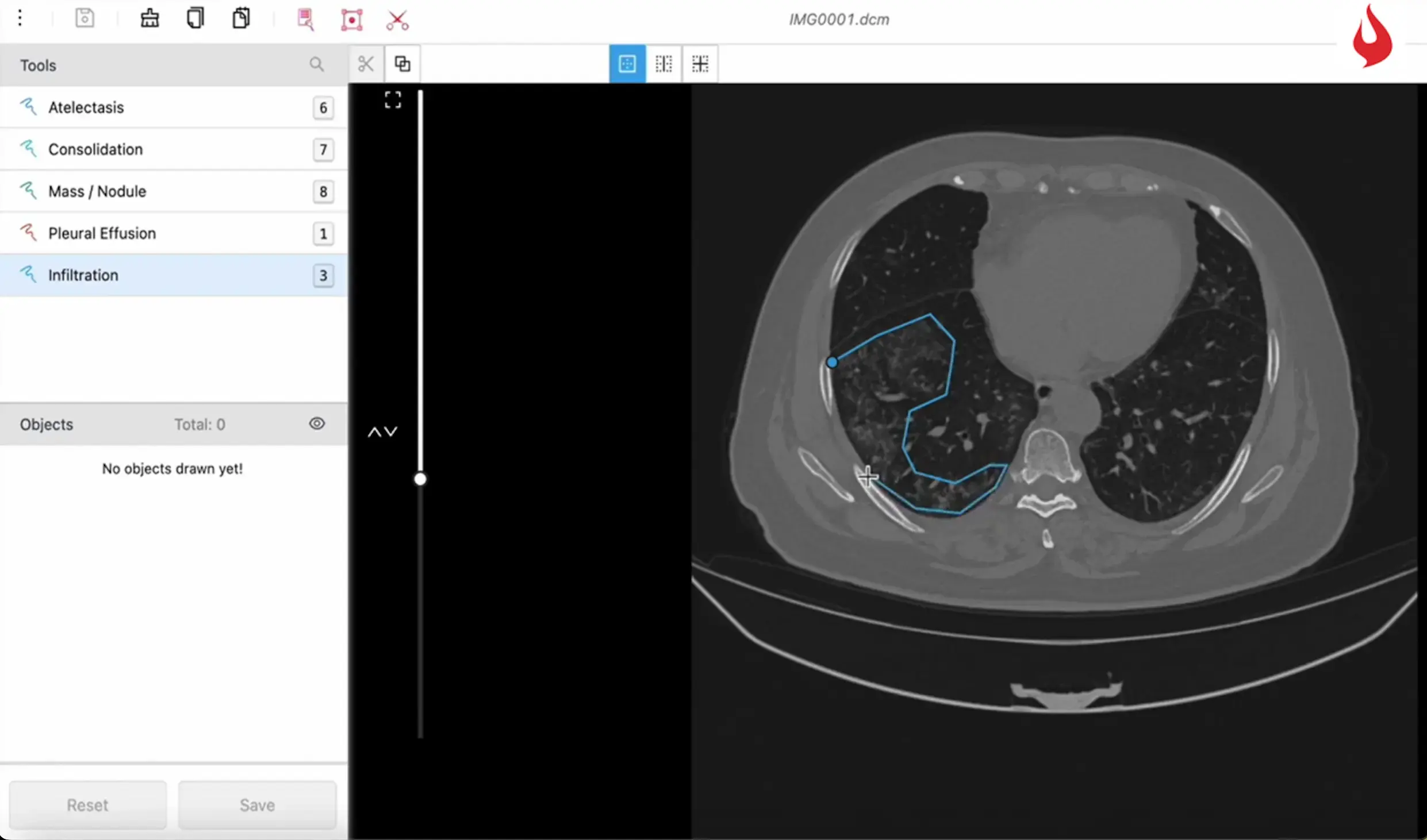 CT lung scan with highlighted Covid-19 infected regions through AI segmentation.