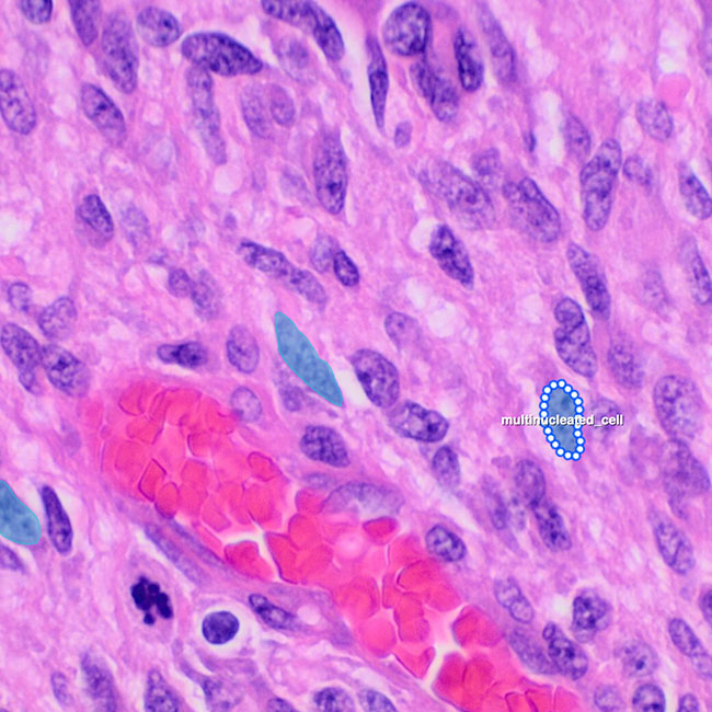 Gliomas & Brain Tumors