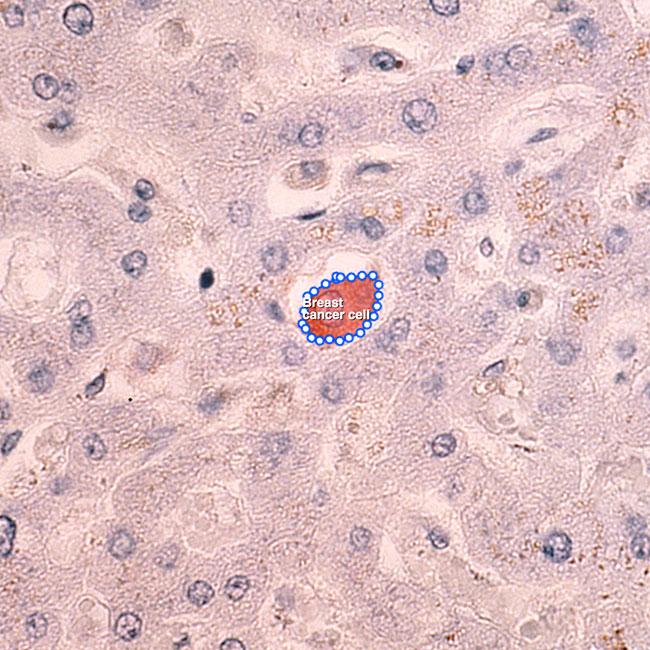 Breast Cancer - Metastasis Detection