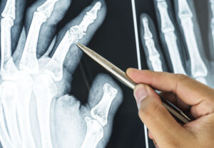 Close-up of a hand X-ray with a pen pointing to a joint