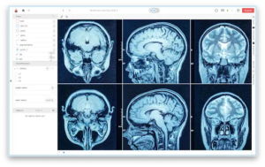 MRI brain scans displayed in a medical annotation tool with labeled regions for analysis and segmentation