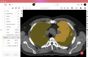 Ango Hub medical image annotation highlighting lungs and a lesion