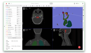 radiology annotation tool showing segmented brain and lung structures in multiple CT scan views