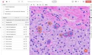 A pathologist examines a digital slide on a computer screen