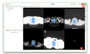 Multi-panel CT scan annotated in the Ango Hub platform with vertebral body and trachea regions marked for medical imaging analysis