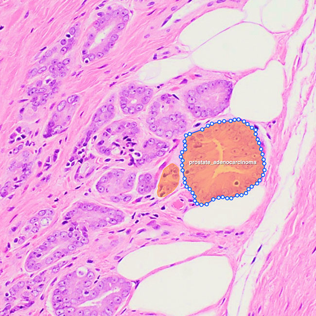 Prostate Cancer