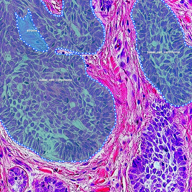 Melanoma & Skin Cancers