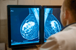 Mammogram screens highlighting a breast mass for AI analysis.