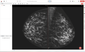 Mammogram screens highlighting a breast mass for AI analysis.