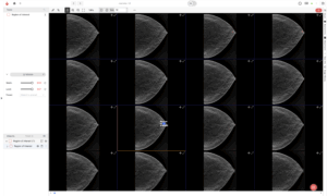 Multi-panel display in the Ango Hub tool showing mammography images for breast imaging analysis