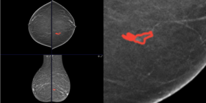 Segmed and iMerit Dataset